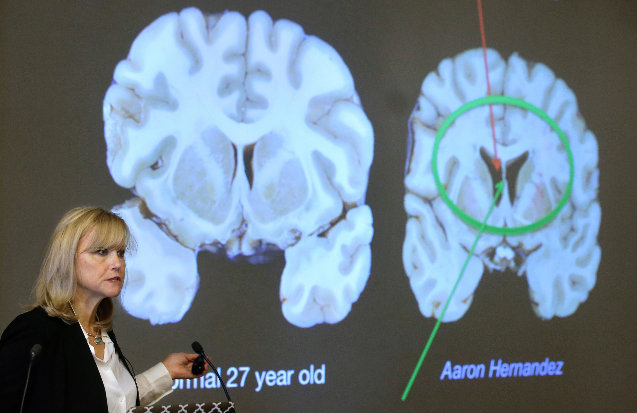 Here's what to know about CTE, the brain disease the NYC shooter blamed ...